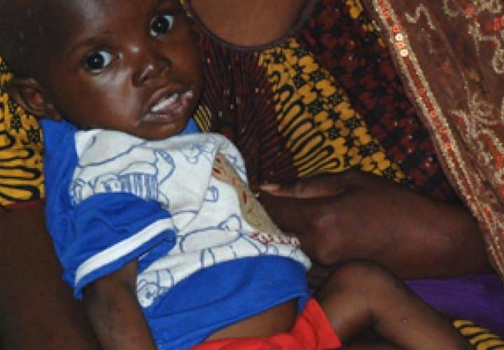 Malnutrition au Mali Enfant souffrant de malnutrition au Mali